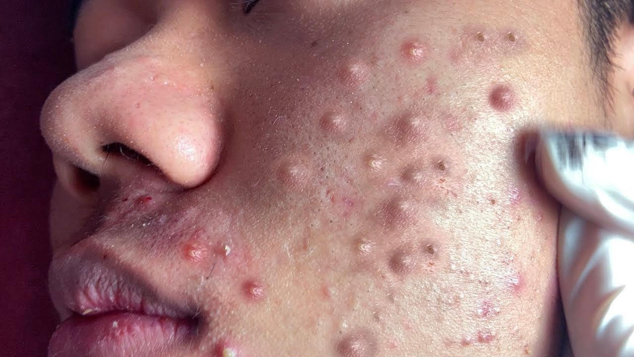 Big Cystic Acne Blackheads Extraction Video Spotter