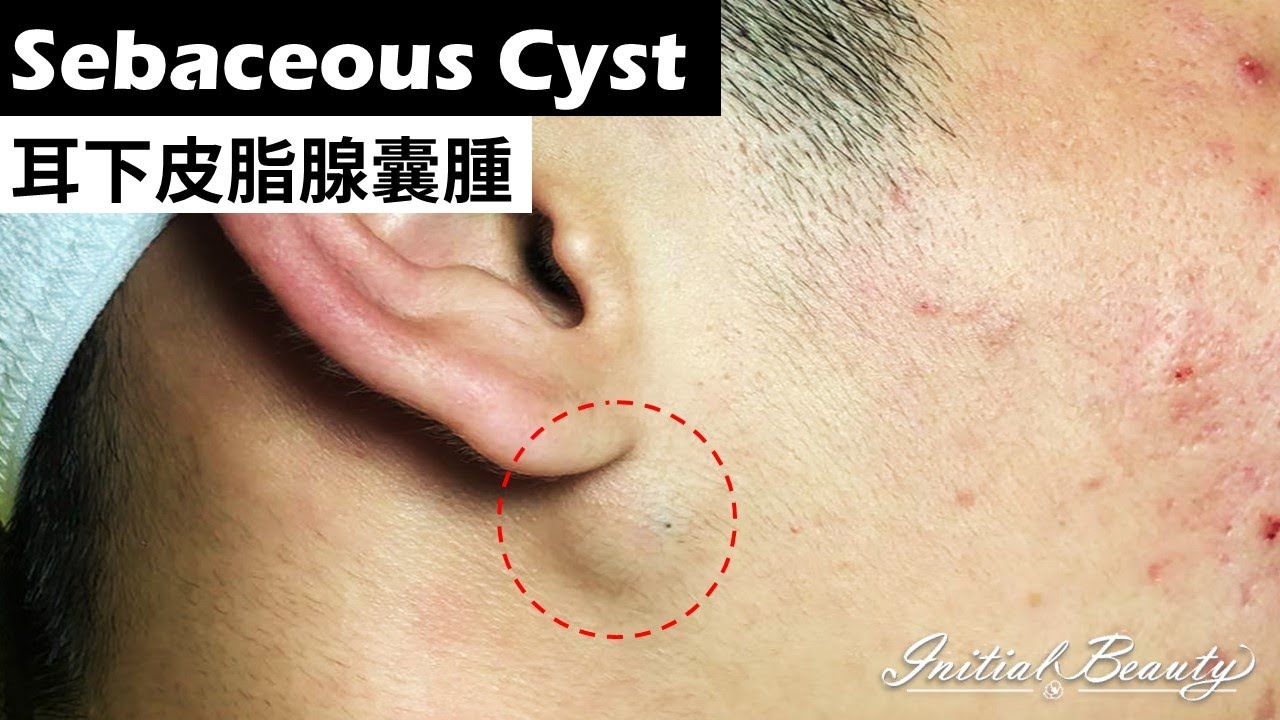 Sebaceous cyst under ear - Video Spotter