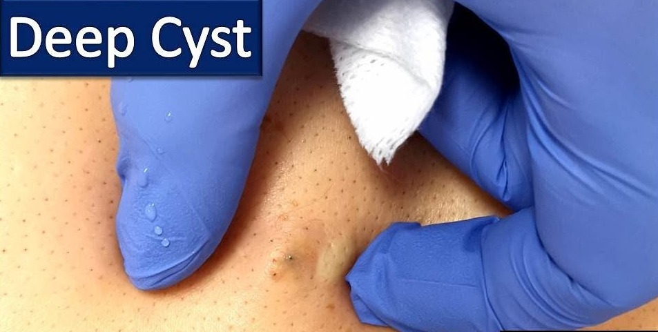 Deep Sebaceous Cyst - Video Spotter