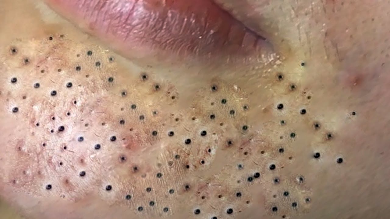 Blackheads Pimples Removal Video Spotter