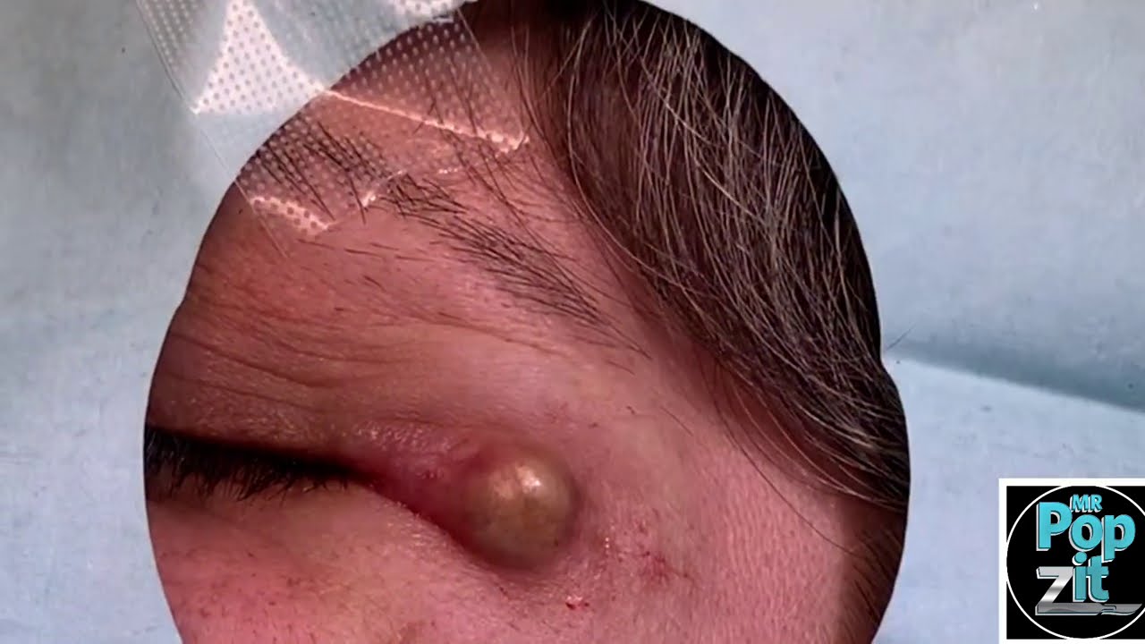 White Mushroom Eyelid Cyst. - Video Spotter