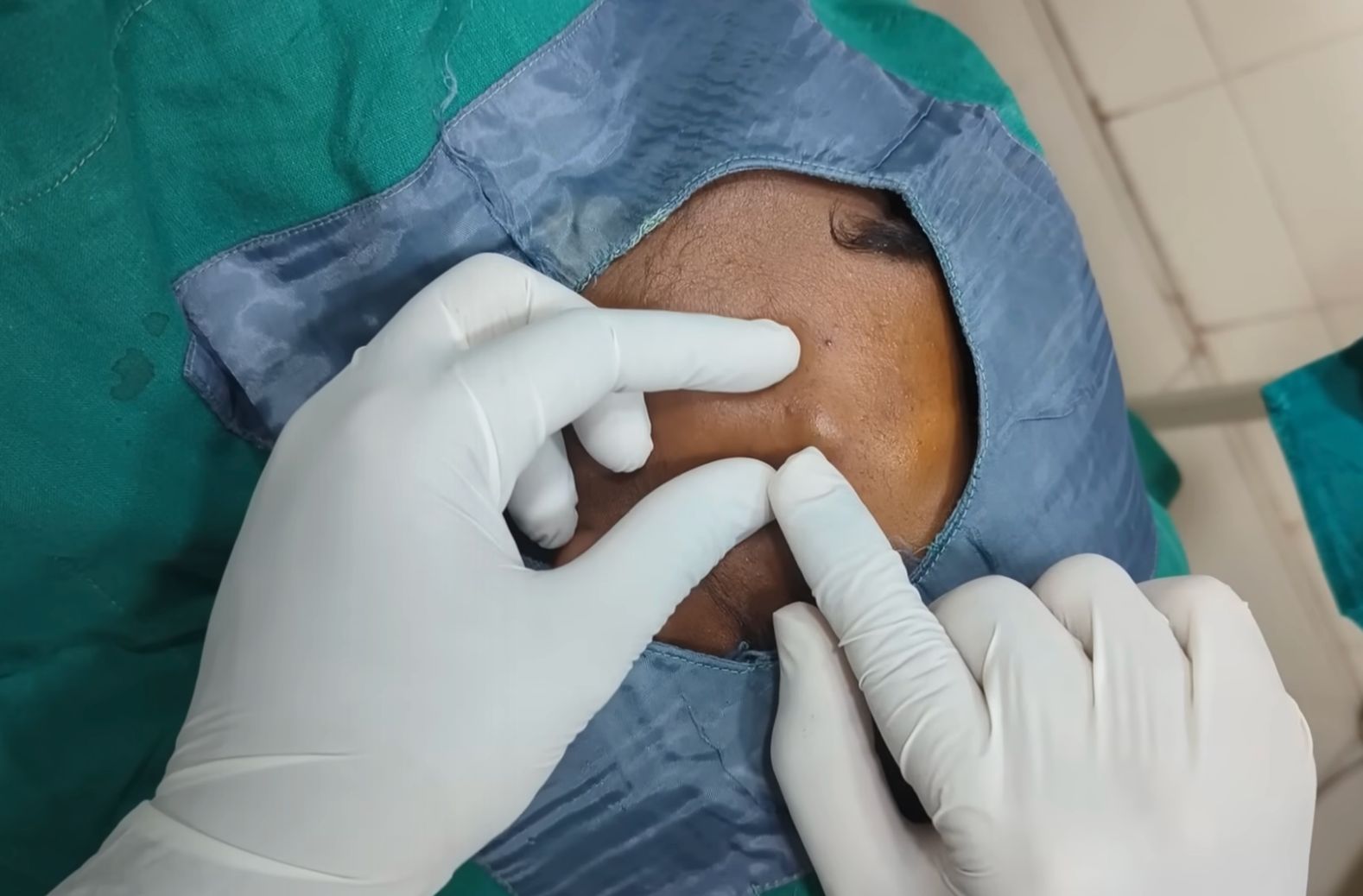 Sebaceous Cyst Removal Video Spotter 2962