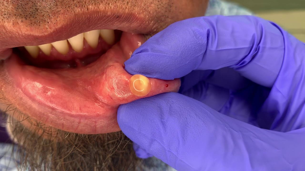 Lower Lip Cyst (Mucocele) Excision - Video Spotter