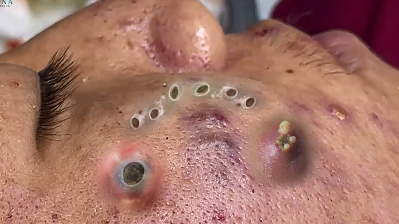 Skin treatment zoomed-in - Video Spotter