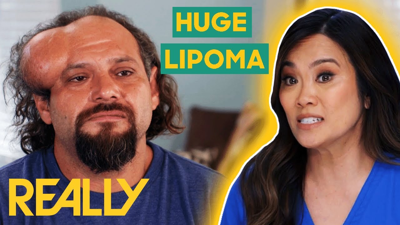 Dr. Lee Removes A HUGE Lipoma From A Patient's Head | Dr. Pimple Popper ...