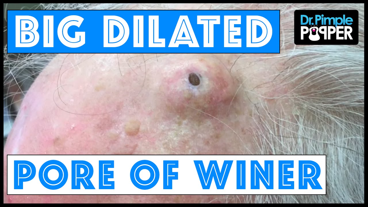 The Biggest Dilated Pore of Winer?! - Video Spotter