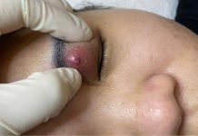 Big Cystic Acne Blackheads Extraction