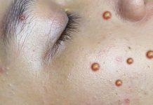 Blackheads Extraction Whiteheads