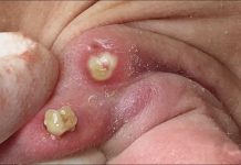 Big Cystic Blackheads Extraction Whiteheads