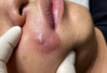 Cystic Blackheads Extraction