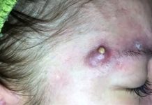 Big Cystic Blackheads Whiteheads