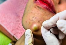 Big Cystic Blackheads Extraction Whitehead