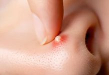 Acne Blackheads and Whiteheads