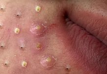 Cystic Acne Blackheads Extraction