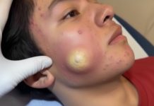 Big Cystic Blackheads