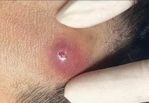 Blackheads Extraction