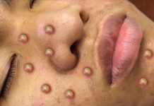 Cystic Blackheads Extraction Whiteheads