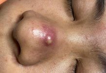 Big Cystic Acne Blackheads Extraction