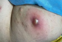 Big Cystic Blackheads