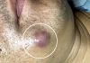 Big Cystic Acne Blackheads Extraction