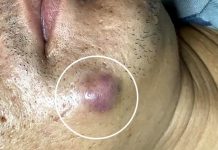 Big Cystic Acne Blackheads Extraction