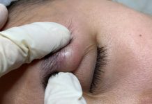 Big Cystic Blackheads Extraction