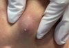 Cystic Blackheads Extraction