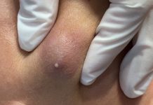 Cystic Blackheads Extraction