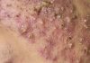Cystic Acne Extraction Blackheads