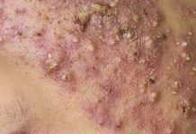 Cystic Acne Extraction Blackheads