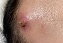 Big Cystic Blackheads