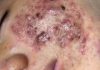 Cystic Acne Blackheads Extraction