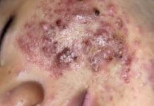 Cystic Acne Blackheads Extraction