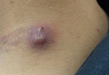 Big Cystic Blackheads Extraction