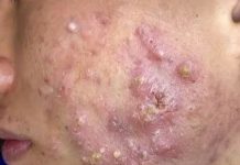 Cystic Acne Blackheads Extraction