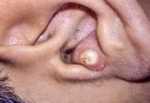 Big Cystic Blackheads