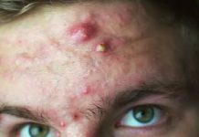 Cystic Acne Extraction Whiteheads