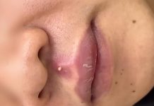 Cystic Extraction Whiteheads