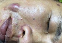 Big Cystic Acne Blackheads