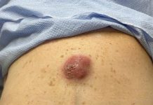 Big Cystic Blackheads Extraction