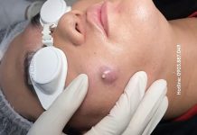 Cystic Acne Blackheads Extraction