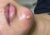 Big Cystic Acne Blackheads Extraction