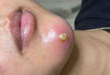 Big Cystic Acne Blackheads Extraction