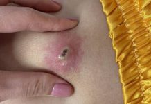 Big Cystic Acne Blackheads