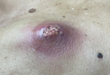 Big Cystic Acne Extraction