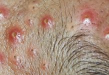 Cystic Acne Blackheads Extraction