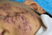 Cystic Acne Extraction Blackheads