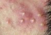 Cystic Acne Blackheads and Whiteheads