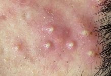 Cystic Acne Blackheads and Whiteheads