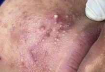 Acne Extraction Pimple Popping